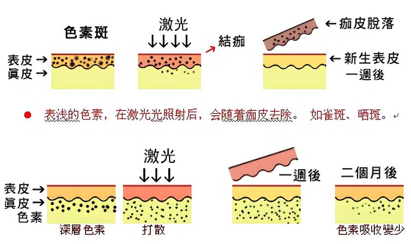 光子嫩肤斑点问题的解决方案

---

第一部分光子嫩肤简介
-**什么是光子嫩肤？**
-定义光子嫩肤是一种利用特定波长的光能量来改善皮肤质地和外观的非侵入性治疗方法。
-技术原理通过选择性光热作用，针对皮肤中的色素、血管等进行治疗。

-**光子嫩肤的适应症**
-常见的皮肤问题色素沉着、雀斑、晒斑、细纹、毛孔粗大等。
-治疗效果改善肤色不均、提亮肤色、减少细纹和毛孔。

---

第二部分斑点问题概述
-**斑点的类型**
-雀斑遗传因素，常见于面部。
-晒斑紫外线暴露导致的色素沉着。
--第1张图片-链上币闻